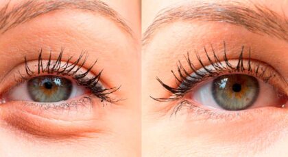 Blepharoplastik