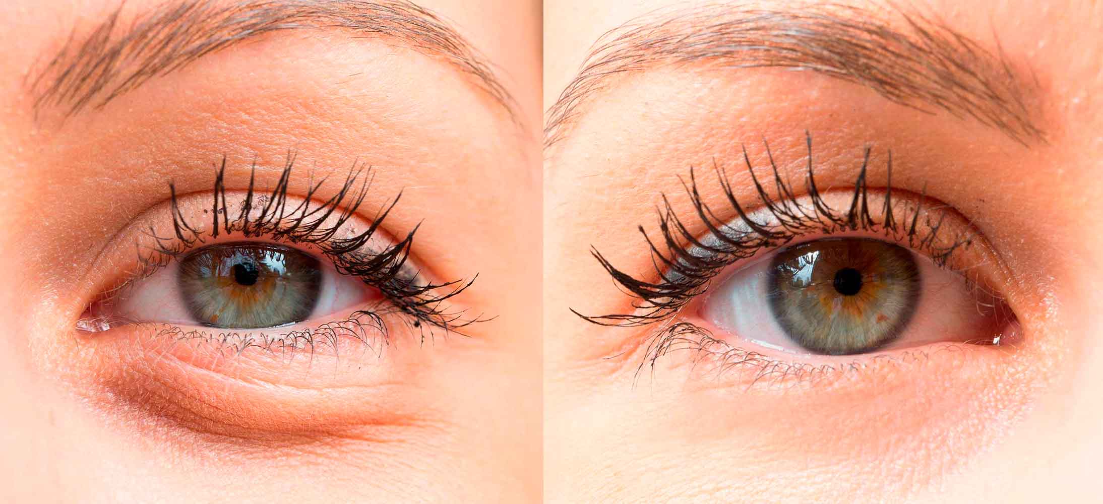 Blepharoplastik